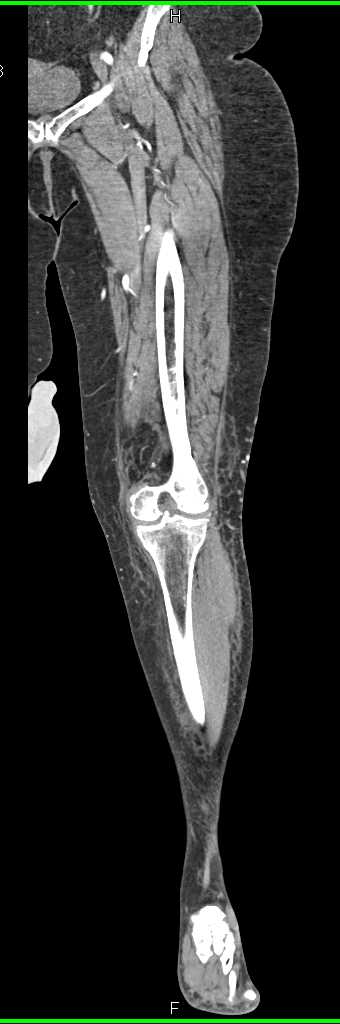 Popliteal Artery Occlusion Post Trauma - CTisus CT Scan