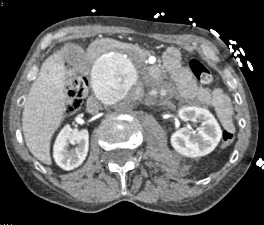 Enlarging and Leaking Abdominal Aortic Aneurysm - CTisus CT Scan