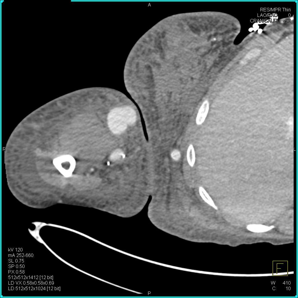 Arteriovenous (AV) Fistulae with Patent Grafts - CTisus CT Scan