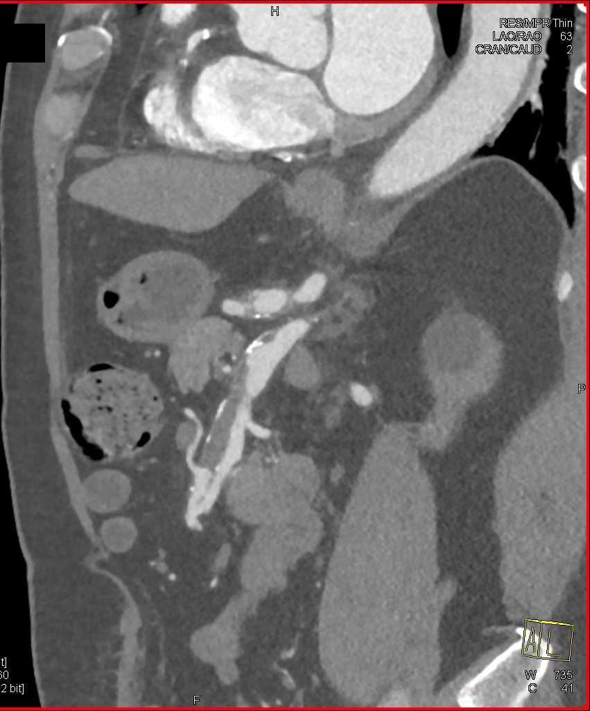 Focal Dissection SMA with Dilated Superior Mesenteric Artery (SMA) and Celiac - CTisus CT Scan