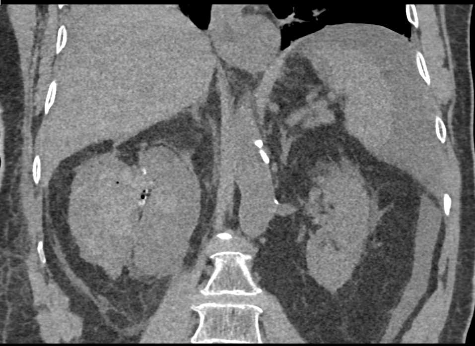 Renal Artery Aneurysm with Active Bleed - CTisus CT Scan