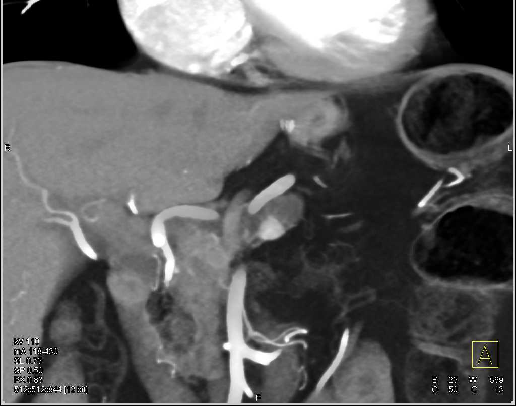 Encased Hepatic Artery - CTisus CT Scan