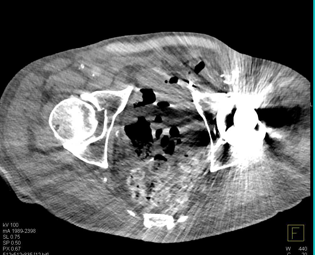 Aortic Aneurysm Repair with Large Endoleak - CTisus CT Scan