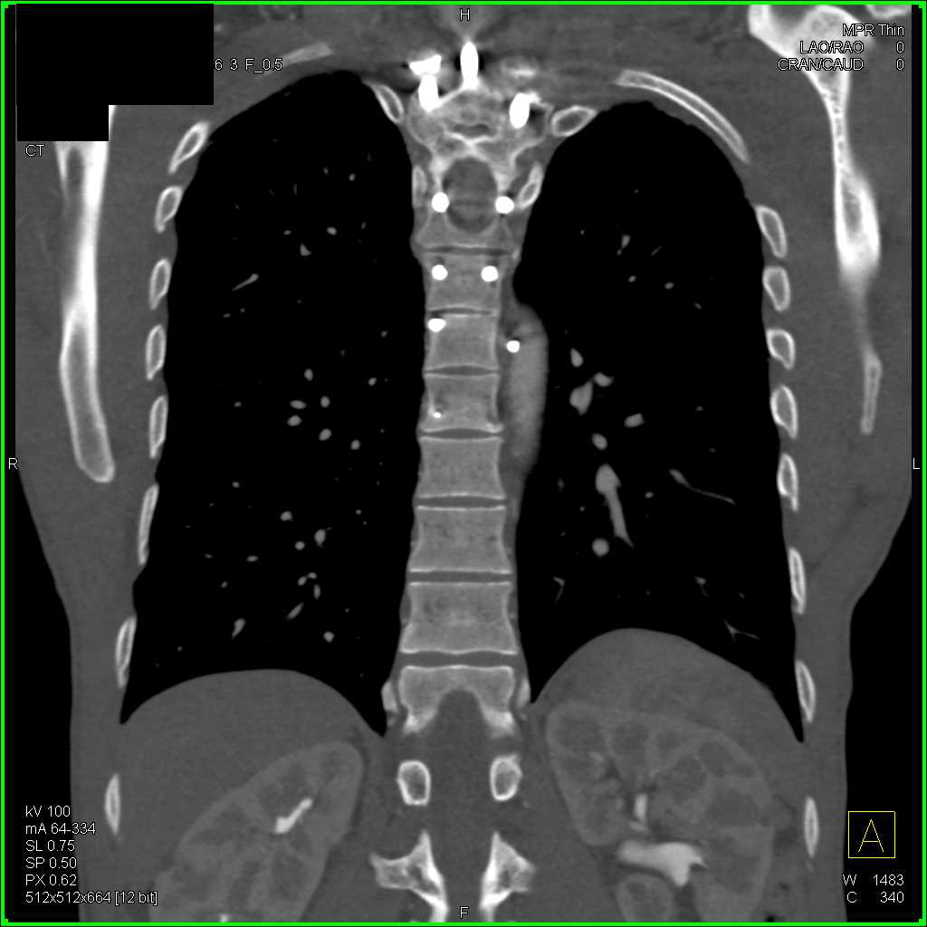 Spinal Hardware Penetrates the Aorta - CTisus CT Scan