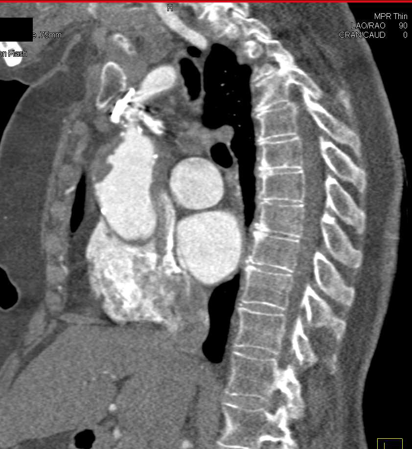 Ulcerations in Ascending Aorta - CTisus CT Scan