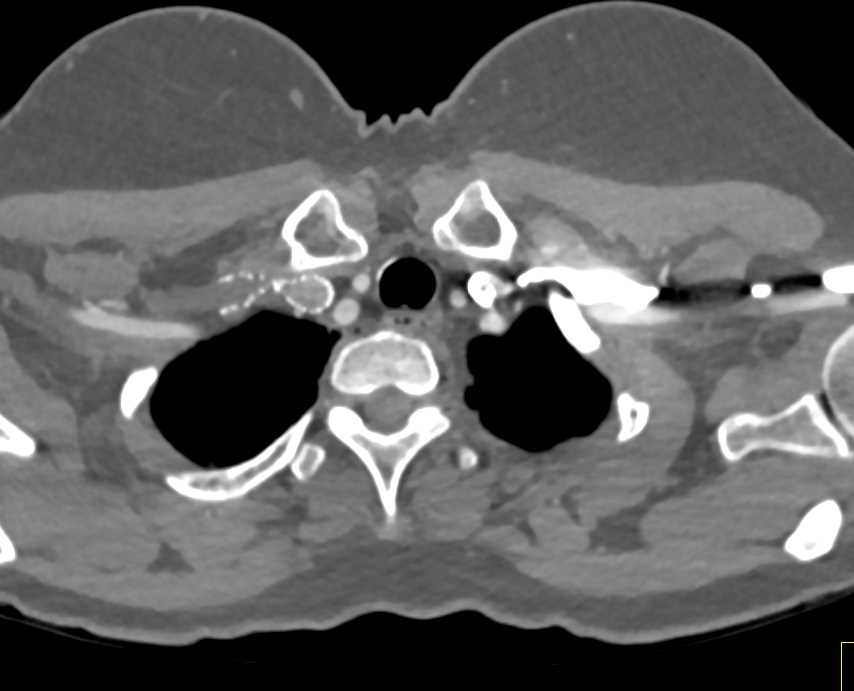 Narrowed Stent in the Right Axillary Vein - CTisus CT Scan