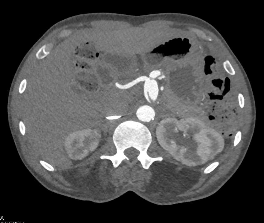 Celiac Artery Aneurysm and Dissection - CTisus CT Scan