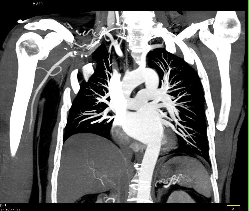 Occlusion Right Axillary Artery - CTisus CT Scan