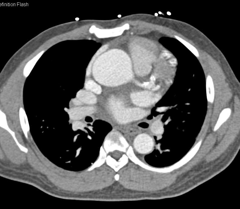 Type A Dissection - CTisus CT Scan