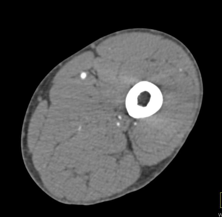 Popliteal Artery Occlusion by Thrombus - CTisus CT Scan