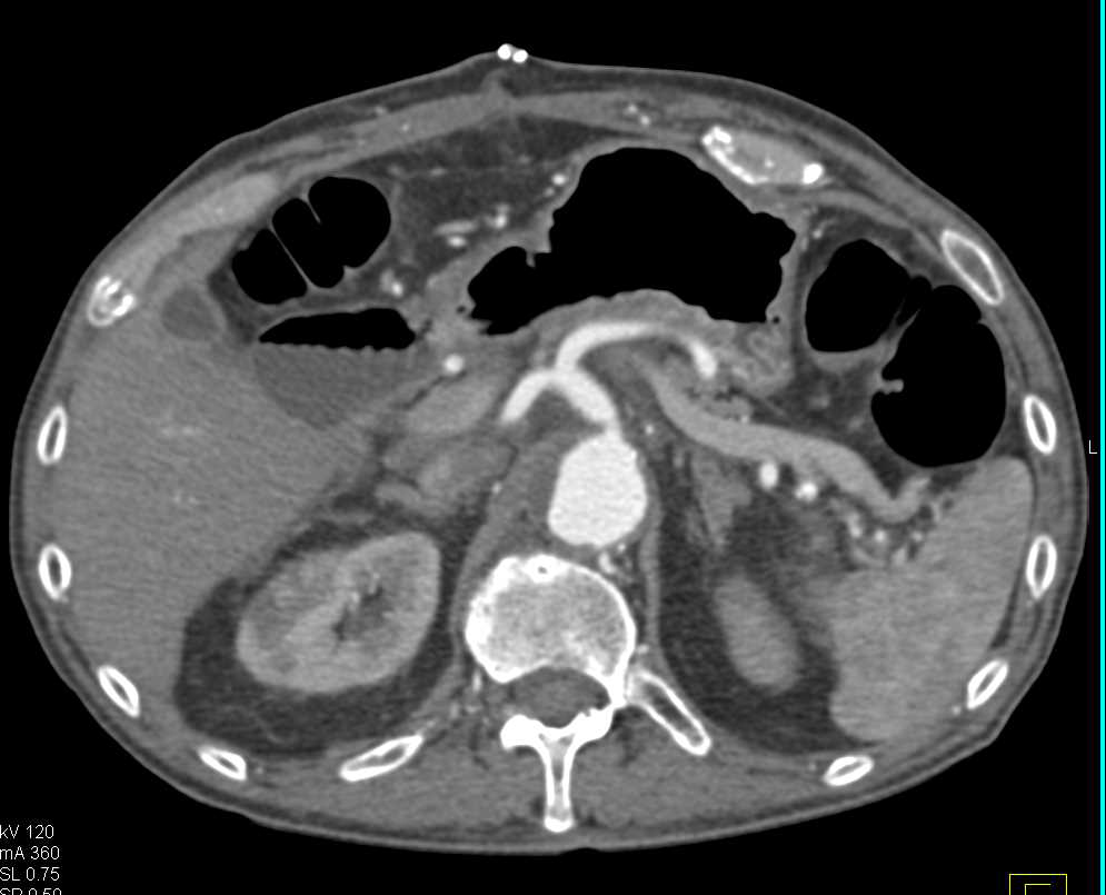 Vascular Grafting with Superior Mesenteric Artery (SMA) Reimplanted on the Left Common Iliac Artery - CTisus CT Scan