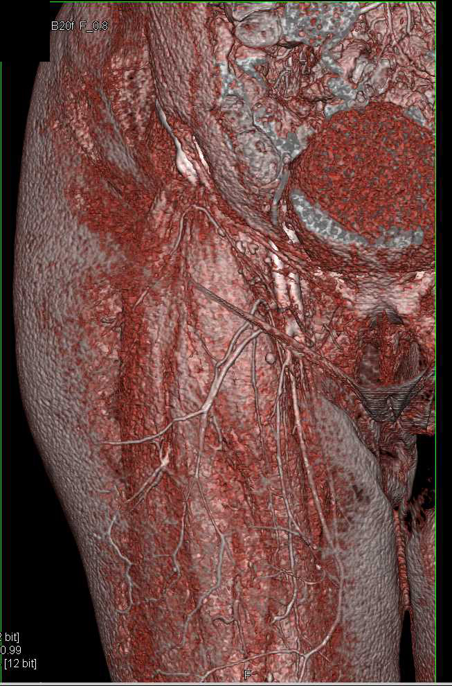 Pseudoaneurysm Right Superficial Femoral Artery (SFA) S/P Trauma - CTisus CT Scan