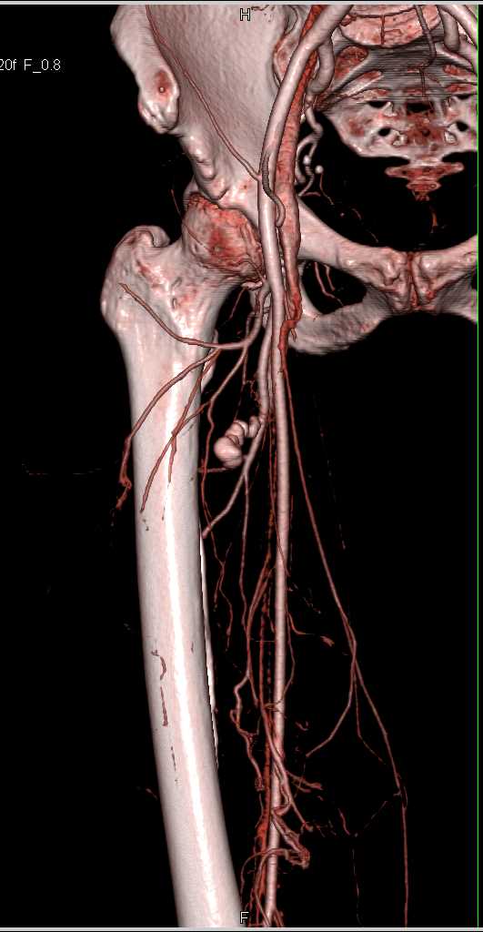 Pseudoaneurysm Right Superficial Femoral Artery (SFA) S/P Trauma - CTisus CT Scan