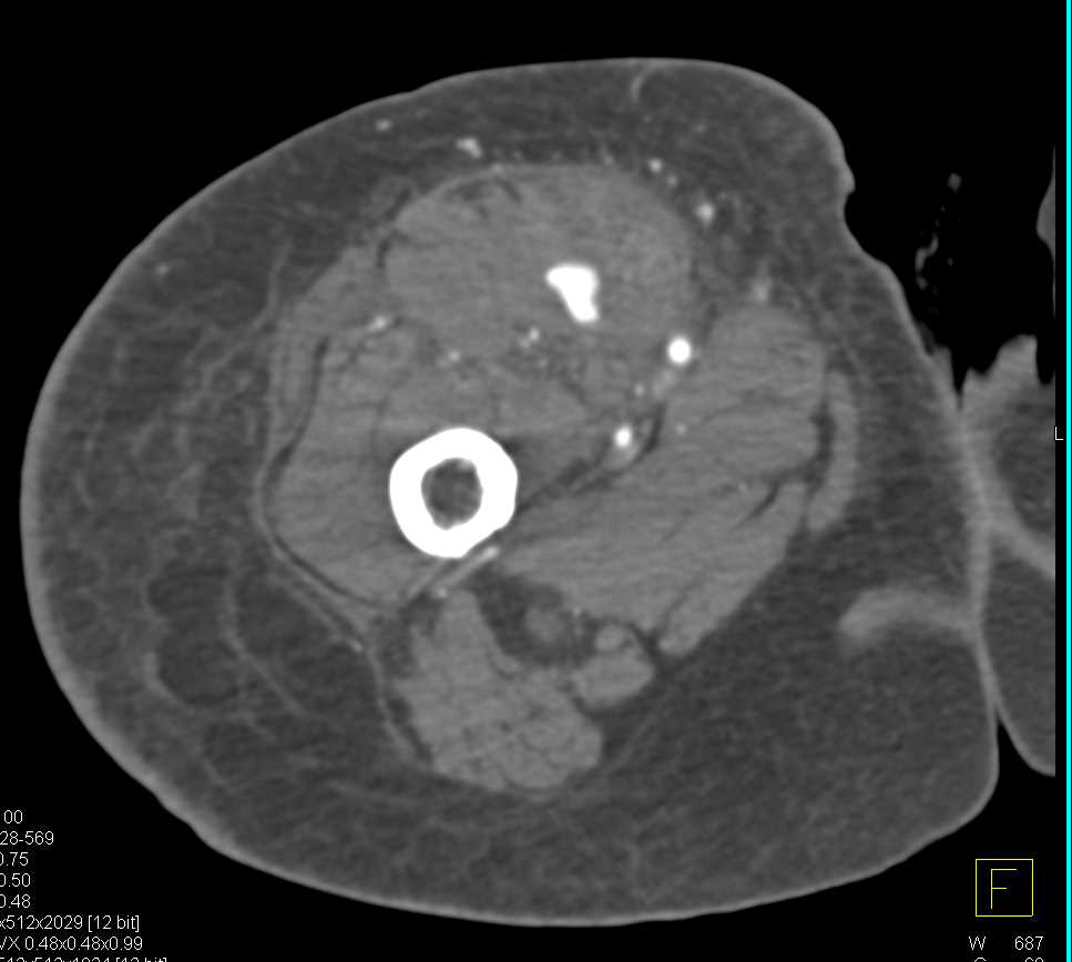 Pseudoaneurysm Right Superficial Femoral Artery (SFA) S/P Trauma - CTisus CT Scan