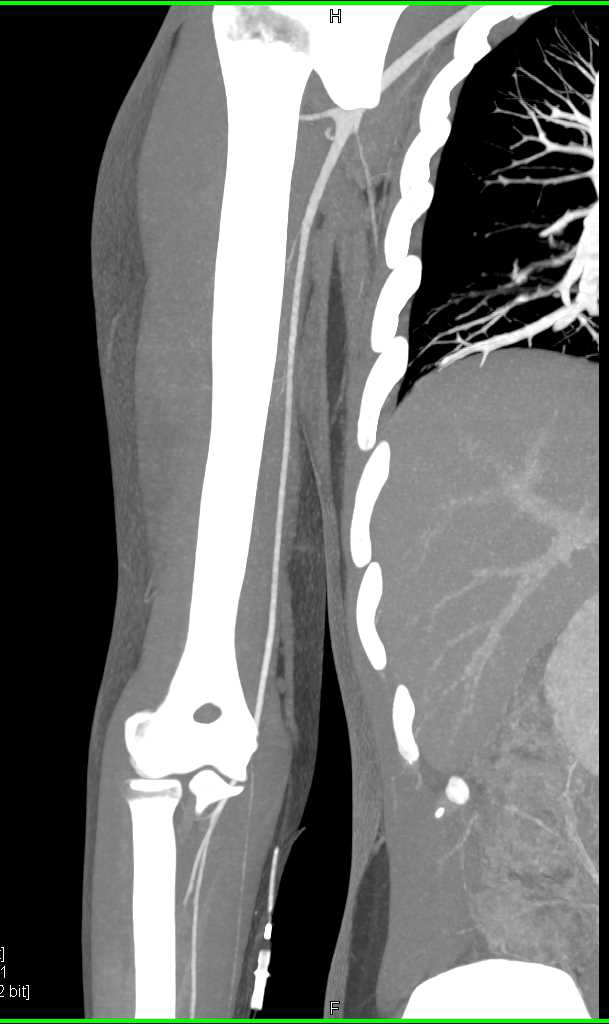 Occlusion of the Radial Artery - CTisus CT Scan