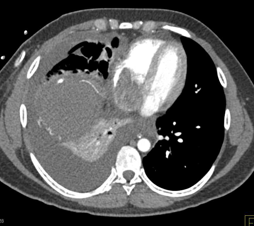 Tumor Invades the Inferior Vena Cava (IVC) - CTisus CT Scan