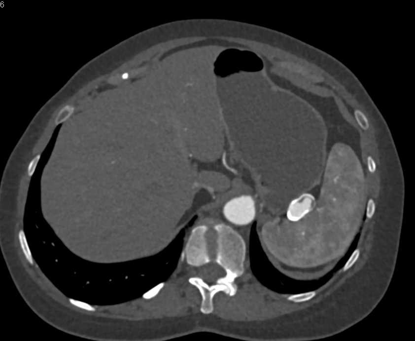 Splenic Artery Aneurysm - CTisus CT Scan