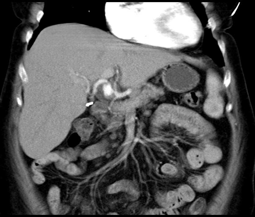 Hepatic Artery Aneurysm - CTisus CT Scan