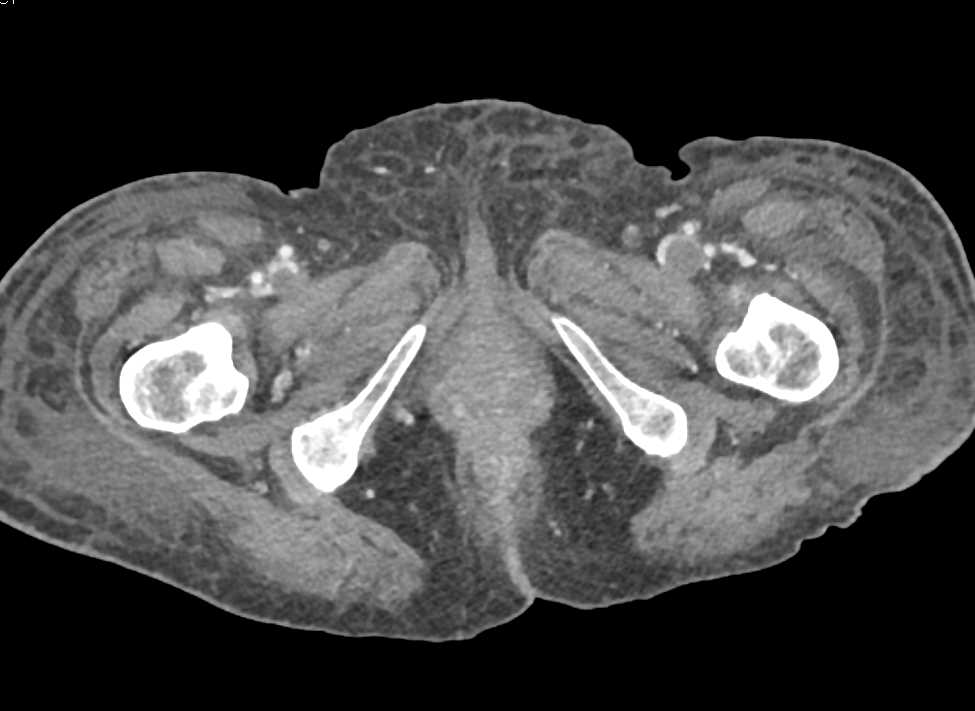 Bilateral Femoral Deep Vein Thrombosis (DVT) - CTisus CT Scan