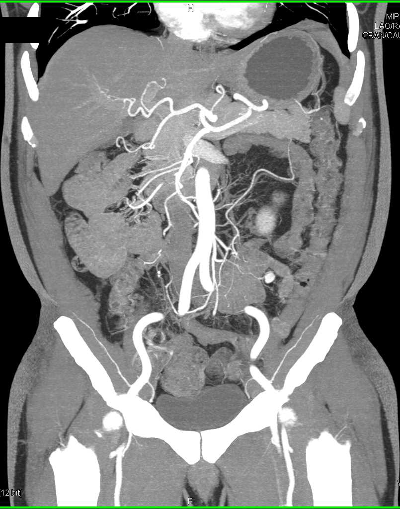 Aneurysm of Mesenteric Vessel - CTisus CT Scan