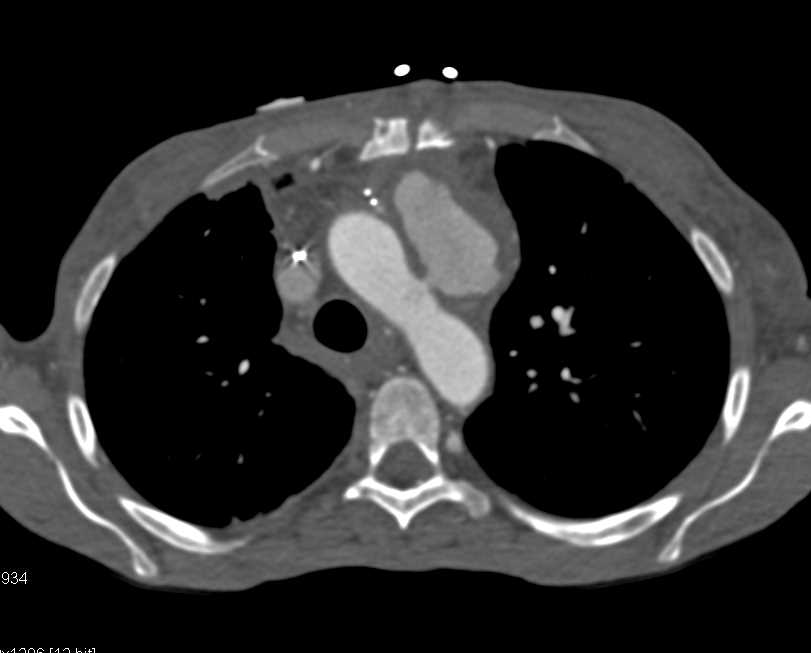 Leaking Aortic Aneurysm - CTisus CT Scan