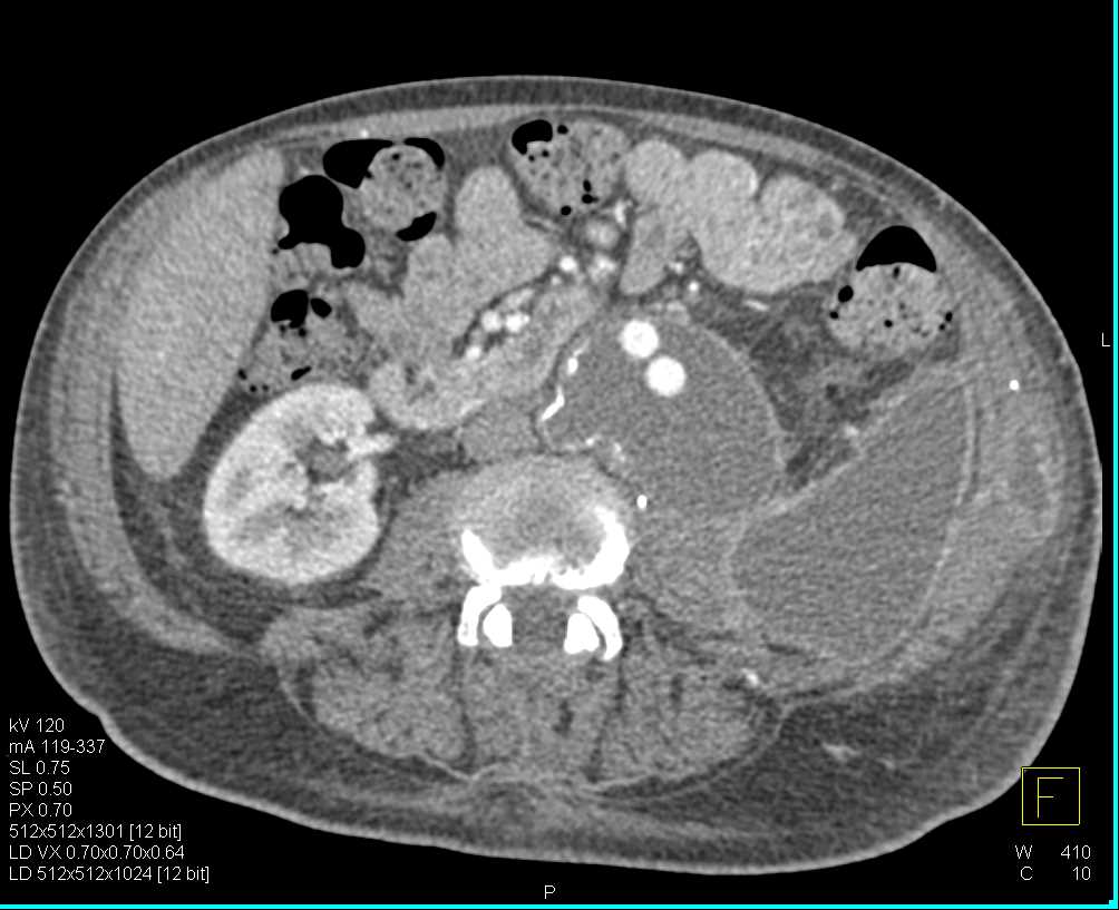 Seroma Post Aneurysm Repair - CTisus CT Scan