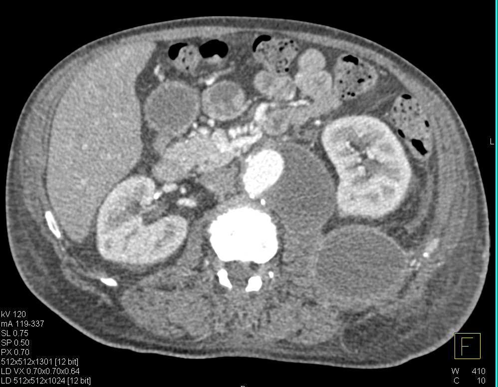 Seroma Post Aneurysm Repair - CTisus CT Scan