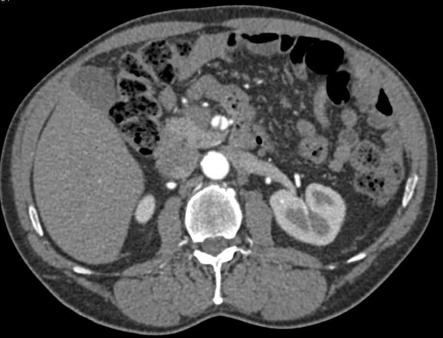 Superior Mesenteric Artery (SMA) Dissection - CTisus CT Scan