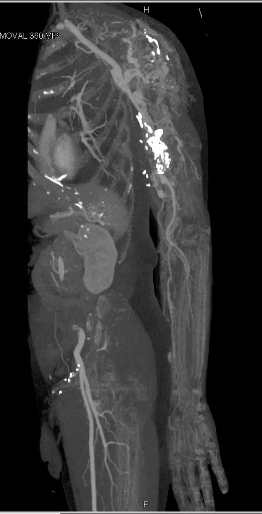 Arteriovenous Malformation (AVM) Left Shoulder - CTisus CT Scan