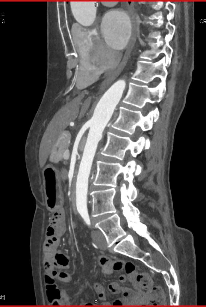 Celiac Artery Dissection - CTisus CT Scan