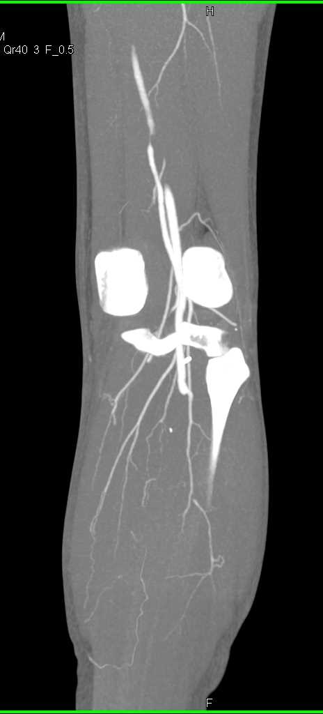 CTA with Occlusion of the Posterior Popliteal Artery - CTisus CT Scan