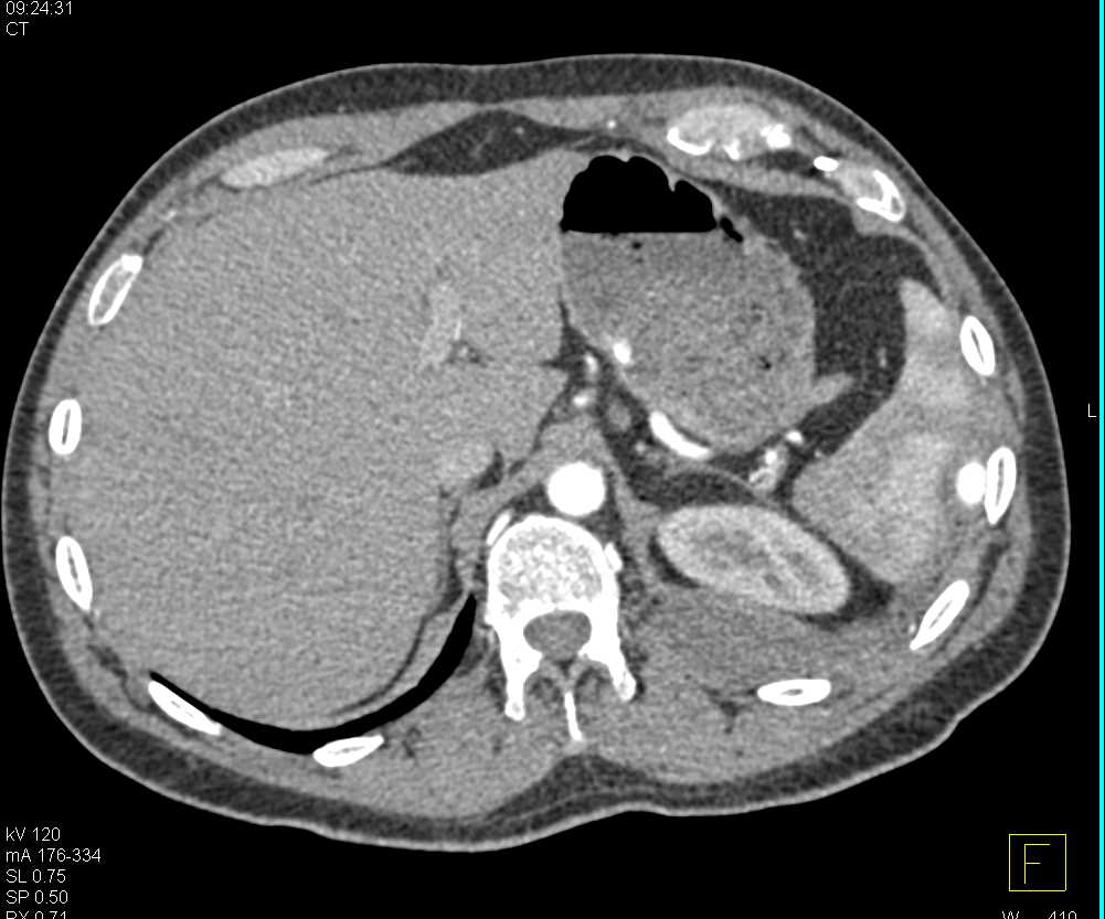 Vascular Aortic Bypass Grafts - CTisus CT Scan