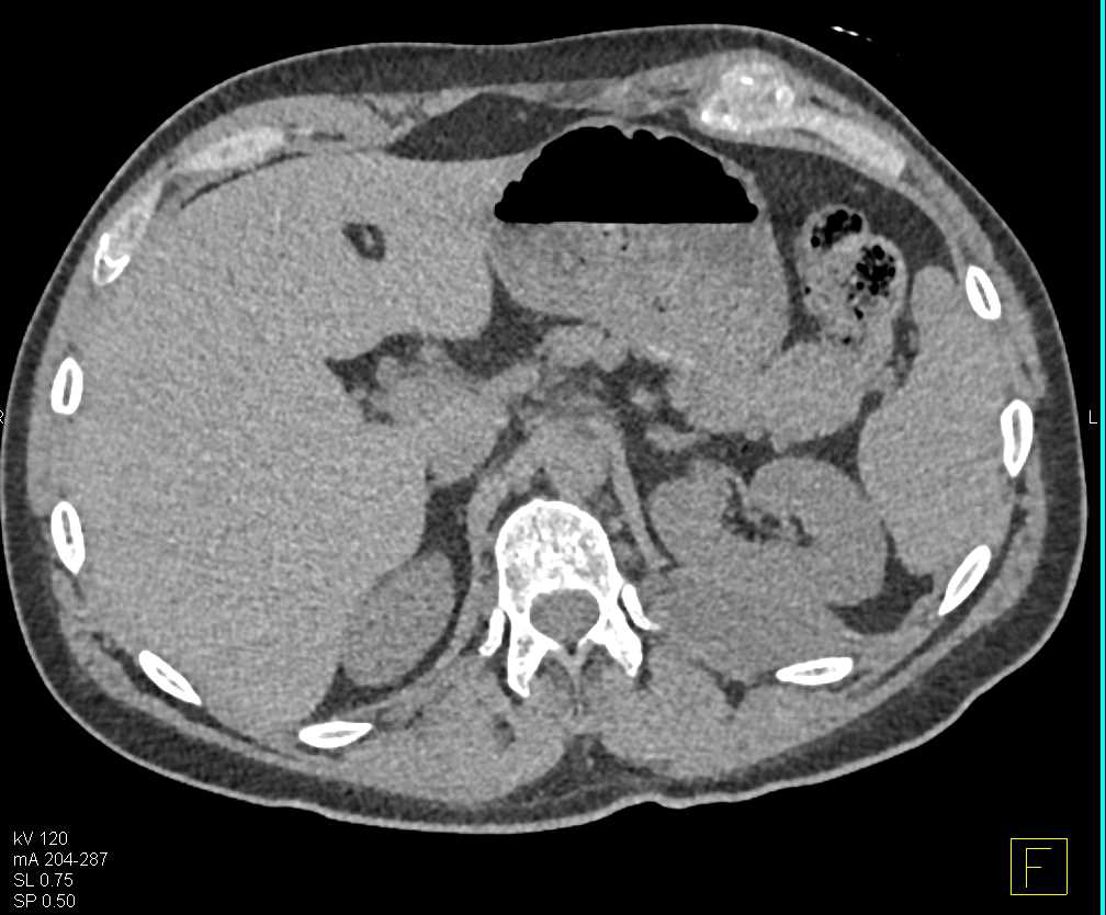 Vascular Aortic Bypass Grafts - CTisus CT Scan