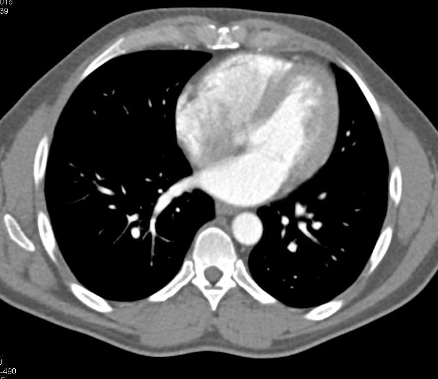 Peripheral Vascular Disease - CTisus CT Scan