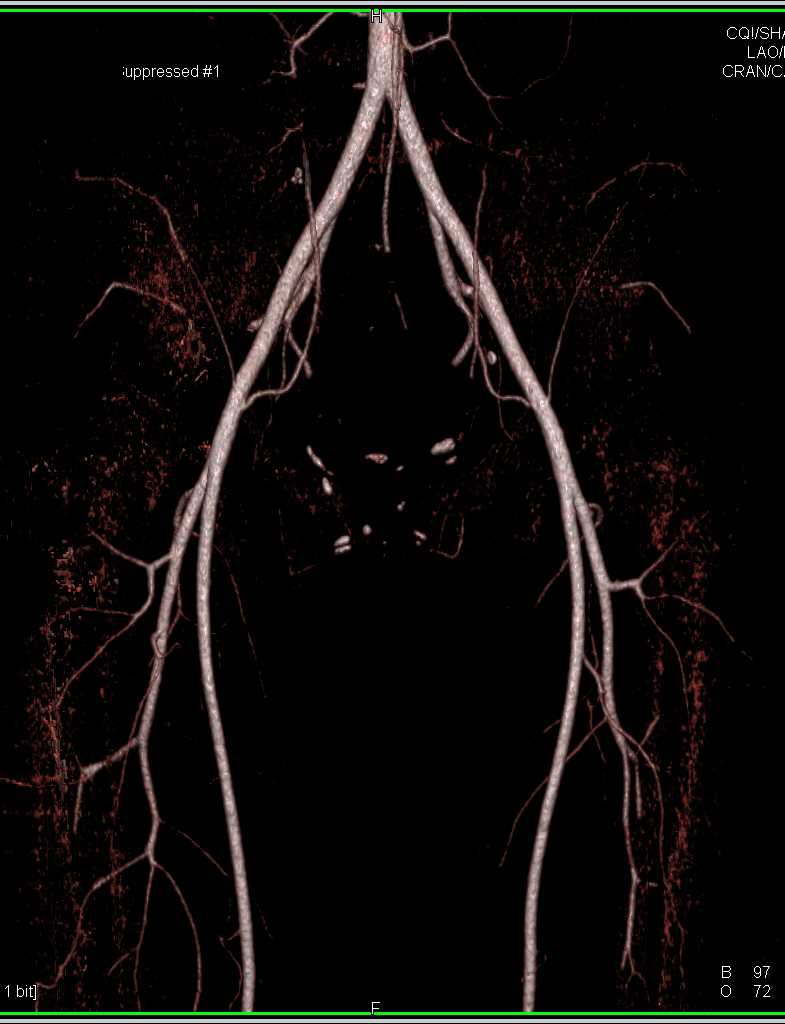 Patent Vasculature in the Pelvis - CTisus CT Scan