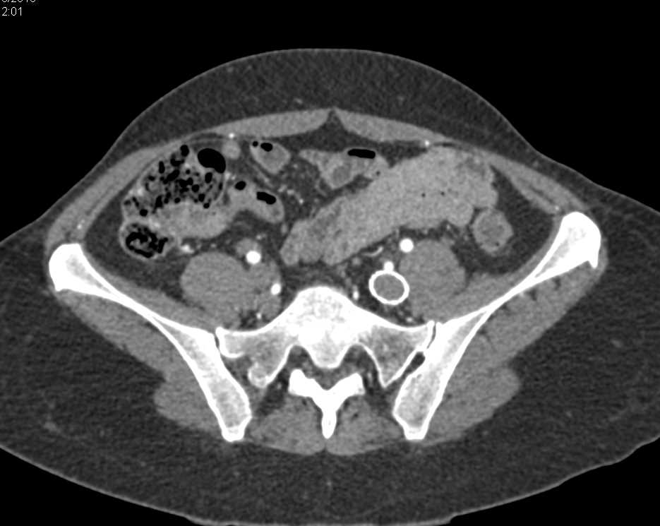 Stent in Left Iliac Vein and Inferior Vena Cava (IVC) - CTisus CT Scan