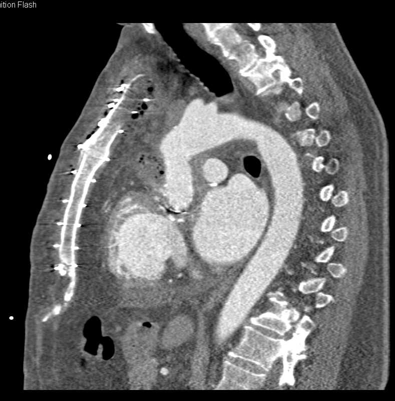 Post Operative Changes S/P Aortic Valve Replacement (AVR) - CTisus CT Scan