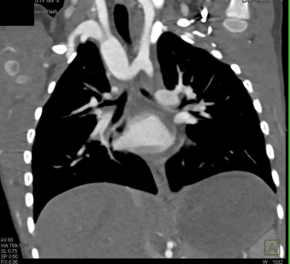 Coarctation Of The Aorta With Extensive Collaterals Vascular Case