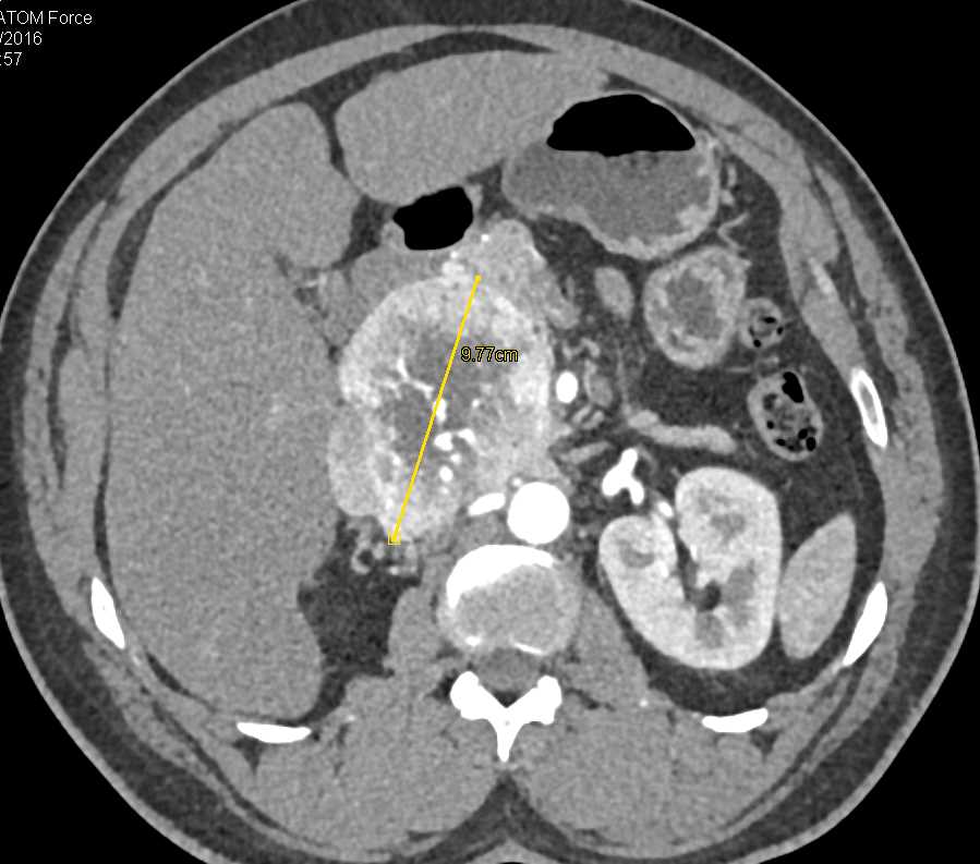 Paraganglioma - CTisus CT Scan