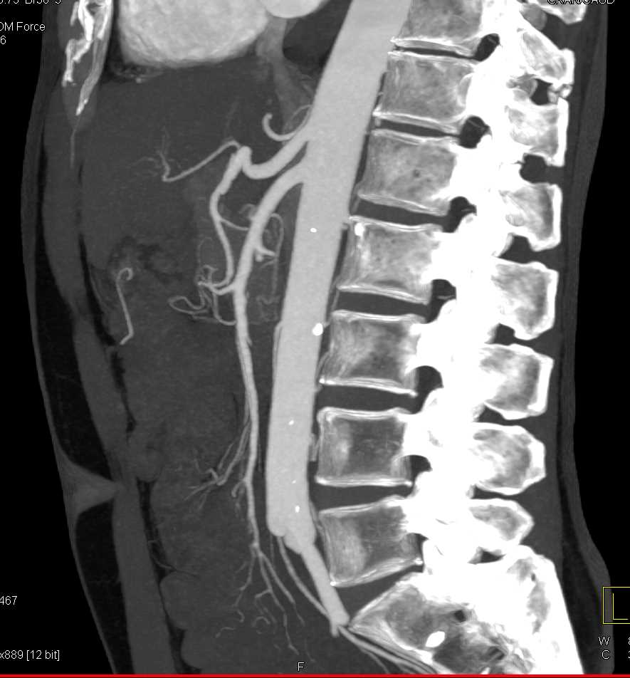 Subtle Superior Mesenteric Artery (SMA) Vasculitis - CTisus CT Scan