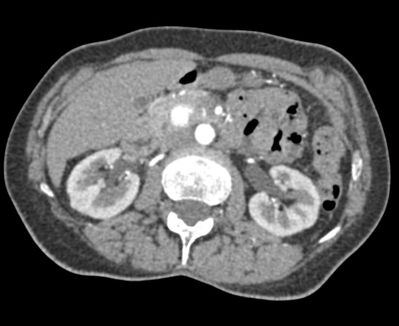 Gastroduodenal Artery (GDA) Pseudoaneurysm - CTisus CT Scan