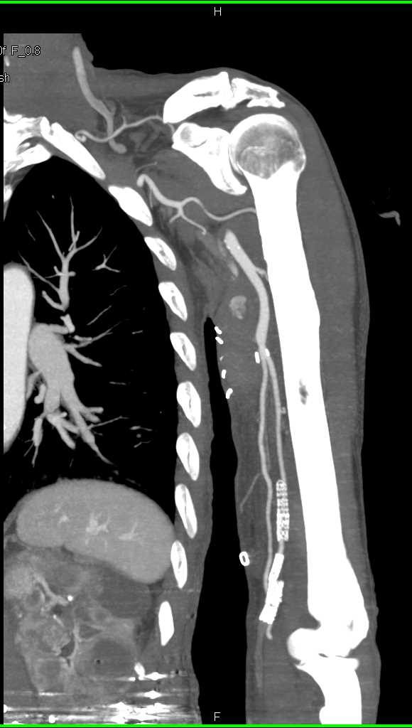 CTA with Vascular Mapping of the Left Upper Extremity - CTisus CT Scan