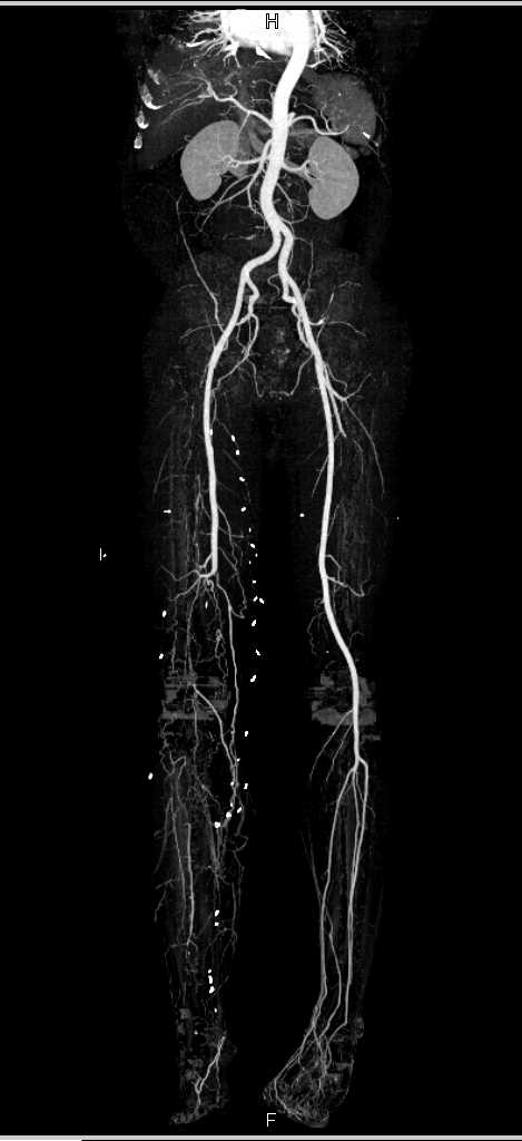 Occlusion of the Right Popliteal Artery - CTisus CT Scan