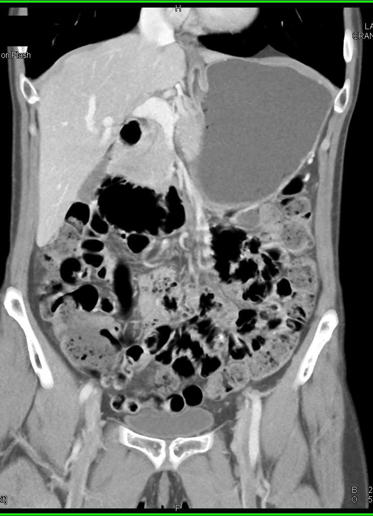 Median Arcuate Ligament Compression - CTisus CT Scan