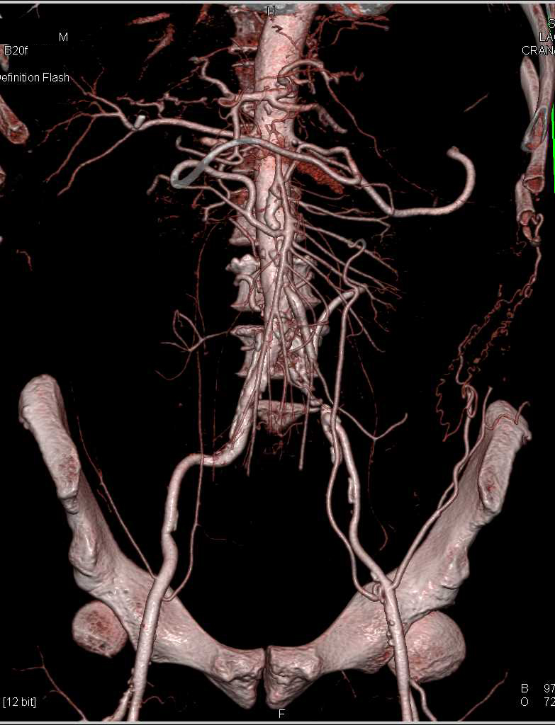 Occlusion of the Left Common Iliac Artery - CTisus CT Scan