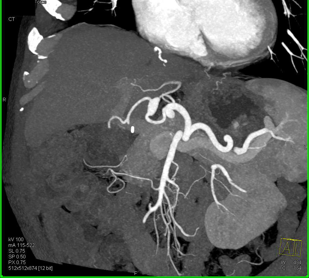 Hepatic Artery Aneurysm - CTisus CT Scan