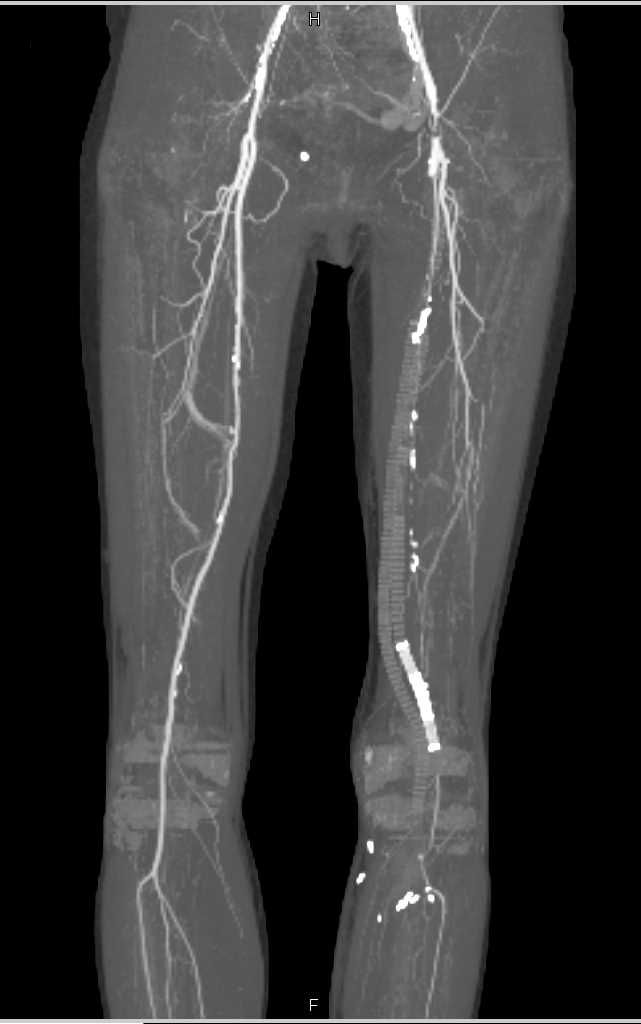 Occlusion of Left Vascular Grafts - CTisus CT Scan