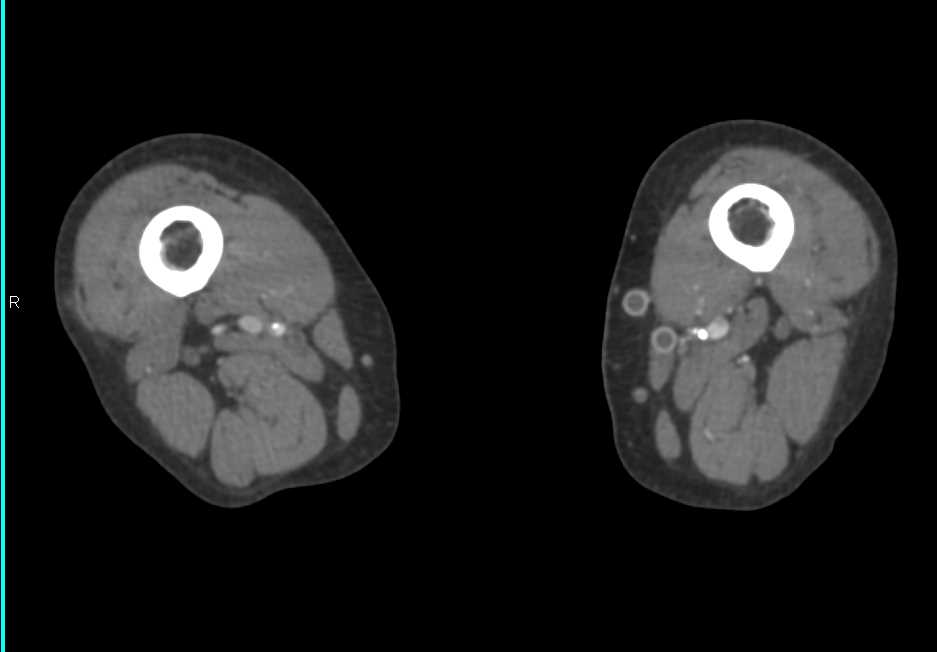 Occlusion of Left Vascular Grafts - CTisus CT Scan