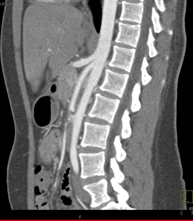 Superior Mesenteric Artery (SMA) Syndrome with Narrowed SMA Angle and Compression of the Left Renal Vein - CTisus CT Scan