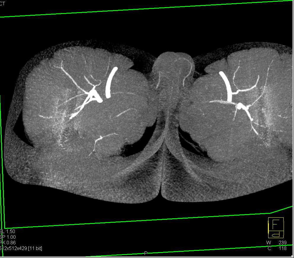 Vascular Mapping for Pelvic Reconstructive Surgery - CTisus CT Scan